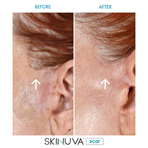 Skinuva - Crema para cicatrices de última generación, crema avanzada para eliminar cicatrices formulada con factores de crecimiento. (50,27 ml)